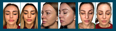 результаты bioGEL PDRN.png